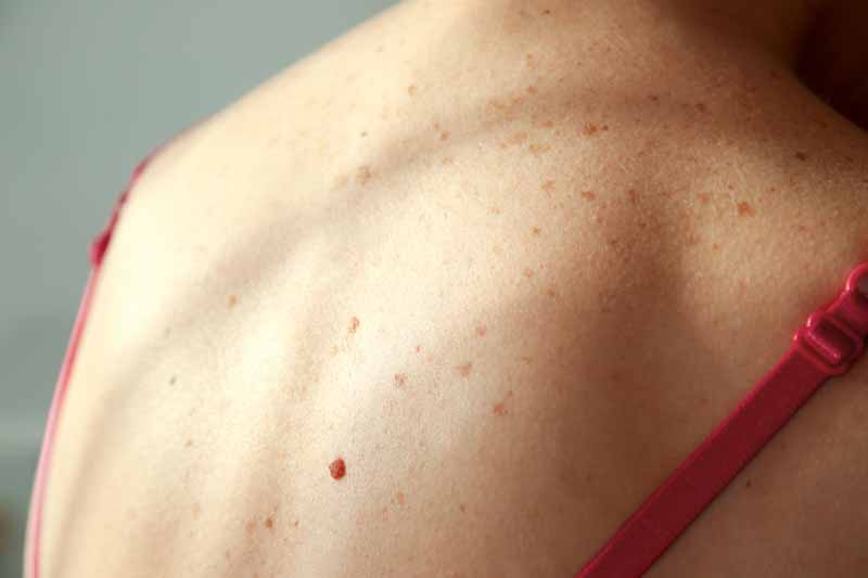 signs of skin cancer