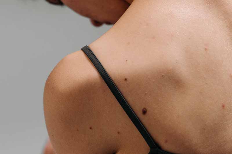 skin cancer signs